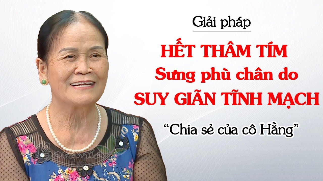 Bí quyết chiến thắng đau nhức, sưng phù, chuột rút khi bị suy giãn tĩnh mạch